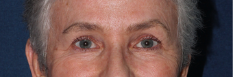 Ulthera Eyes | Before and After after 1033980