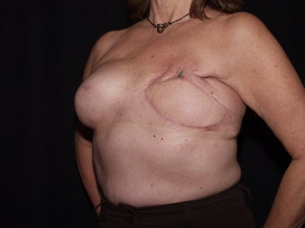 59 year old breast cancer survivor with failed breast reconstruction looking for revision 1289201