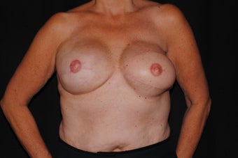 59 year old breast cancer survivor with failed breast reconstruction looking for revision after 1289201