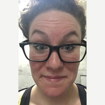 25-34 year old woman treated with Botox before 3787526