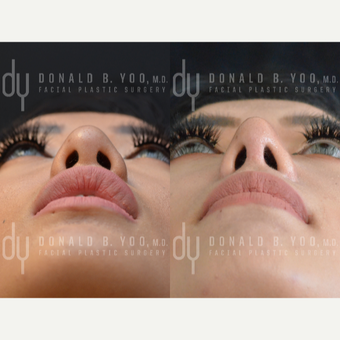 Asian Rhinoplasty before 3739392