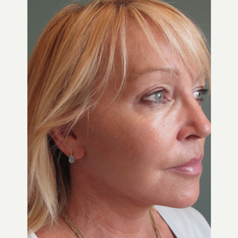 45-54 year old woman treated with Facelift after 3713464