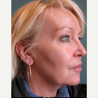 45-54 year old woman treated with Facelift before 3713464
