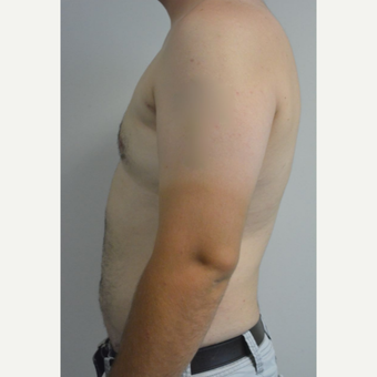 25-34 year old man treated with Male Breast Reduction after 3175427