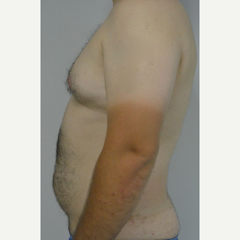 25-34 year old man treated with Male Breast Reduction before 3175427