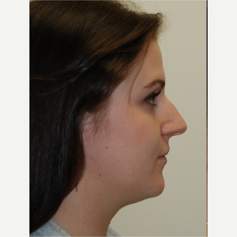 25-34 year old woman treated with Rhinoplasty and permanent Lip Augmentation. before 3742334