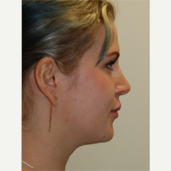 25-34 year old woman treated with Rhinoplasty and permanent Lip Augmentation. after 3742334