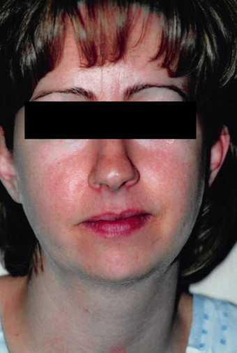35-44 year old woman treated with Buccal Fat Removal before 1588055
