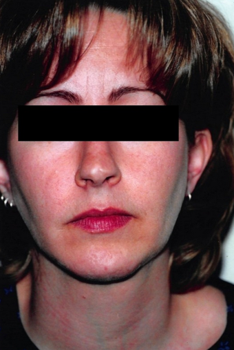 35-44 year old woman treated with Buccal Fat Removal after 1588055