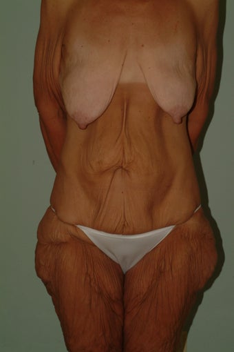 Total body makeover before 1059180