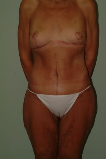 Total body makeover after 1059180
