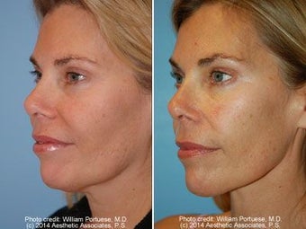 Necklift before 56383