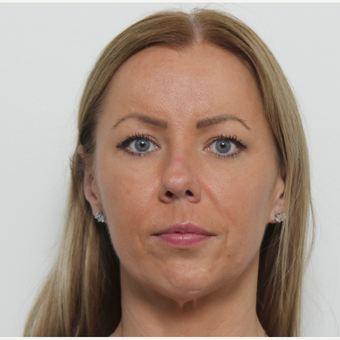 35-44 year old woman treated with Rhinoplasty before 3406143