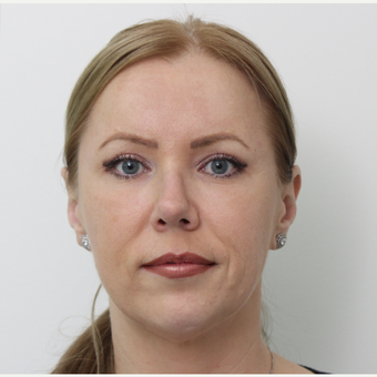 35-44 year old woman treated with Rhinoplasty after 3406143