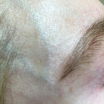 55-64 year old woman treated with Vein Treatment before 3079396