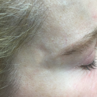 55-64 year old woman treated with Vein Treatment after 3079396