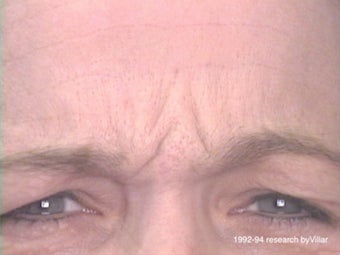 Frown Line Treatment before 985038