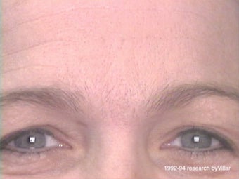 Frown Line Treatment after 985038