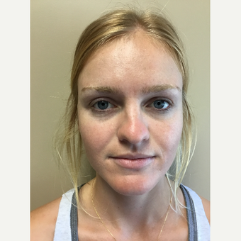 18-24 year old woman treated with Rhinoplasty before 3180296