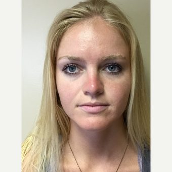 18-24 year old woman treated with Rhinoplasty after 3180296