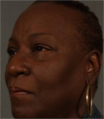 59 Year Old African American female after Juvederm Voluma used to fill her cheeks and NEW use- nasolabial folds after 1344888