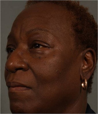 59 Year Old African American female after Juvederm Voluma used to fill her cheeks and NEW use- nasolabial folds before 1344888