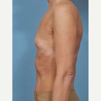 45-54 year old woman treated with Breast Fat Transfer before 2286243