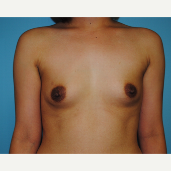 18-24 year old woman treated with Breast Augmentation before 3031462