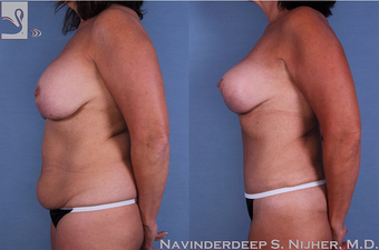 55-64 year old woman treated with Mommy Makeover-57351 after 3768776