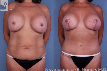 55-64 year old woman treated with Mommy Makeover-57351 before 3768776