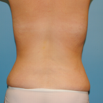 25 year old woman treated with Liposuction of her love handles (flanks) after 3339933