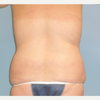 25 year old woman treated with Liposuction of her love handles (flanks) before 3339933