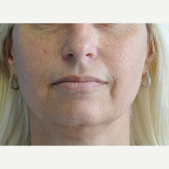 45-54 year old woman treated with Lip Augmentation before 3219501
