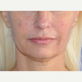 45-54 year old woman treated with Lip Augmentation after 3219501