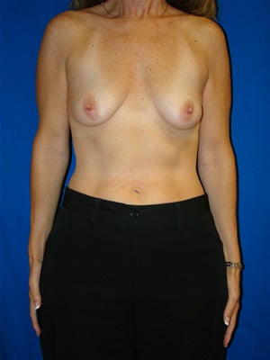Breast Augmentation Surgery before 112639
