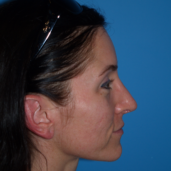 25-34 year old woman treated with Rhinoplasty after 3323937