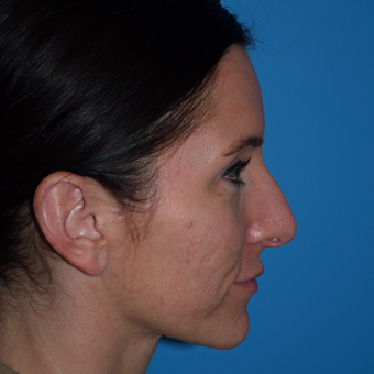 25-34 year old woman treated with Rhinoplasty before 3323937