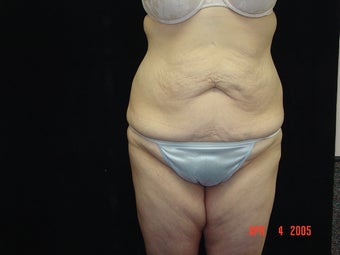 Body Lift with Liposuction of Abdomen, Waist, Flanks before 203454