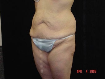 Body Lift with Liposuction of Abdomen, Waist, Flanks 203454