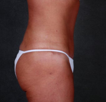 Tummy Tuck with Liposuction after 1057118
