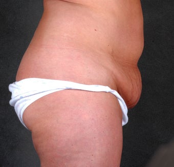 Tummy Tuck with Liposuction before 1057118