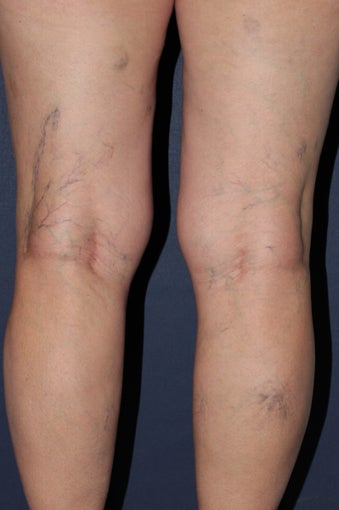 62 year old female treated with Sclerotherapy for Leg Veins before 986681