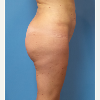 35 old woman treated with Brazilian Butt Lift after 3506609