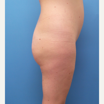 35 old woman treated with Brazilian Butt Lift before 3506609