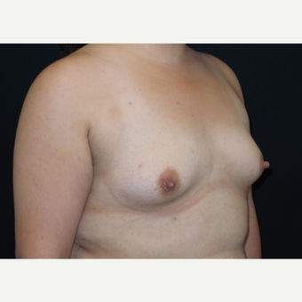 25-34 year old woman treated with Breast Augmentation before 3182011