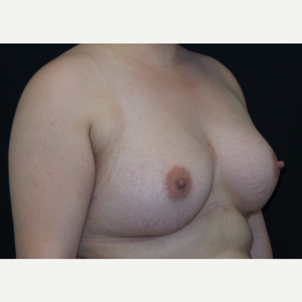 25-34 year old woman treated with Breast Augmentation after 3182011