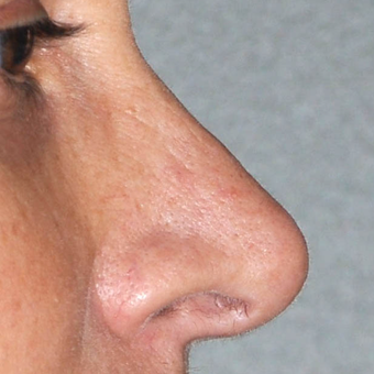 45-54 year old woman treated with Rhinoplasty after 3173413