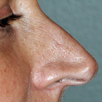 45-54 year old woman treated with Rhinoplasty before 3173413