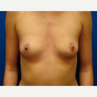 18-24 year old woman treated with Breast Implants before 3669995
