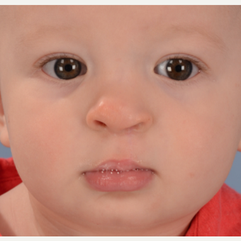 17 or under year old man treated with Cleft Lip And Palate Repair after 3639057